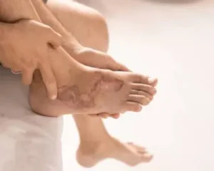 Debrisan®: Polvo cicatrizante con dextranómero para heridas difíciles de sanar