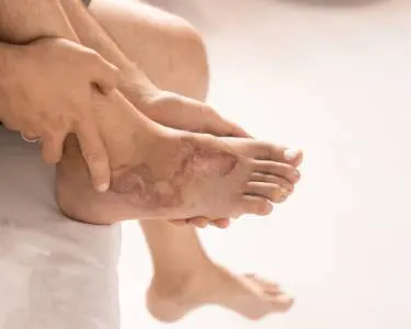 heridas complicadas debrisan